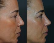 Rinoplastia antes e depois no Porto: perfil direito, correção de bossa e ponta caída